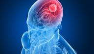 صورة مقال مراحل سرطان الدماغ