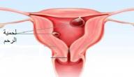 صورة مقال ما هي لحمية الرحم