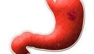 صورة مقال آثار قرحة المعدة
