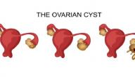 صورة مقال التخلص من كيس على المبيض
