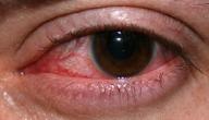 صورة مقال التهاب القرنية