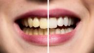 صورة مقال طريقة تبيض الاسنان