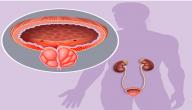 صورة مقال التهاب البروستاتا البكتيري