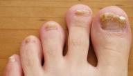 صورة مقال علاج فطريات الأظافر طبيعياً