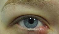 صورة مقال أسباب وجود كيس دهني في العين
