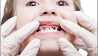 صورة مقال كيف أعالج تسوس الأسنان