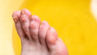 صورة مقال كيفية علاج تورم أصبع القدم الكبير