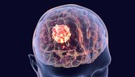 صورة مقال كيفية معرفة ورم الرأس