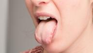 صورة مقال ما علاج تقرحات اللسان