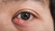 صورة مقال التهاب بكتيري في العين