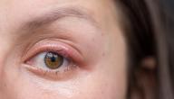 صورة مقال ما أسباب انتفاخ العين