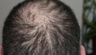 صورة مقال ما سبب تساقط الشعر عند الرجال