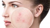 صورة مقال كيفية علاج آثار حب الشباب طبيعياً