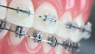 صورة مقال أنواع تقويم الأسنان