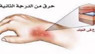 صورة مقال كيف نعالج الحروق من الدرجة الثانية