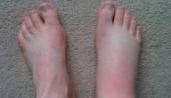 صورة مقال ما أسباب تورم القدمين