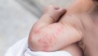 صورة مقال ما أسباب الطفح الجلدي عند الاطفال