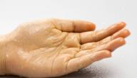 صورة مقال ما أسباب تعرق اليدين والقدمين