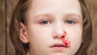 صورة مقال ما أسباب الرعاف عند الاطفال