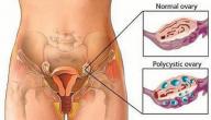 كيف يتم علاج تكيس المبايض