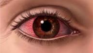 صورة مقال ما علاج احمرار العين