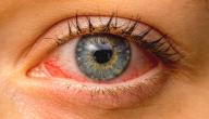 صورة مقال ما هي الأمراض التي تصيب العين