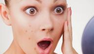 صورة مقال ما أفضل علاج لحب الشباب