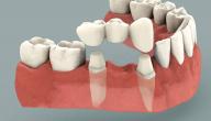 صورة مقال ما هو جسر الأسنان