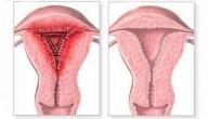 صورة مقال ما هي أعراض التهابات الرحم