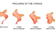 صورة مقال ما هي أعراض نزول الرحم
