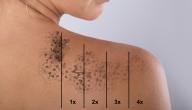 صورة مقال طرق إزالة الوشم
