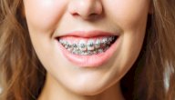 صورة مقال تقويم الأسنان ينحف
