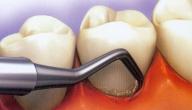 صورة مقال طريقة تنظيف اللثة