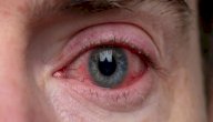 صورة مقال ما هو سبب احمرار العين