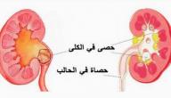 صورة مقال حصى الكلى أسبابها وعلاجها
