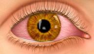 صورة مقال حول العين المفاجئ