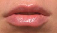 صورة مقال كيف أتخلص من سواد الشفاه