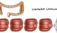 صورة مقال سرطان القولون هل هو مميت