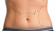 صورة مقال شفط البطن للداخل بعد الولادة