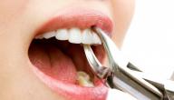 صورة مقال كيف يتم خلع الضرس