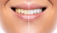 صورة مقال أفضل طريقة لتبيض الأسنان