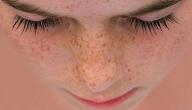 صورة مقال إزالة النمش