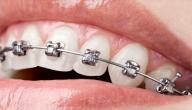 صورة مقال فوائد تقويم الأسنان