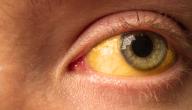صورة مقال علاج صفار العين