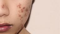 صورة مقال آثار حب الشباب في الوجه