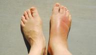 صورة مقال ما سبب تورم القدمين