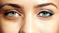 صورة مقال علاج السواد حول العين
