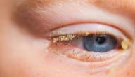 صورة مقال علاج رمد العين للأطفال