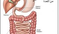 أضرار عملية تحويل مسار المعدة