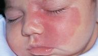 ظهور بقع حمراء على الوجه